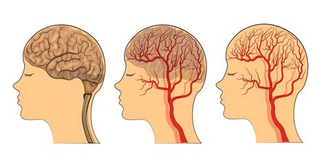 Lesiones Vasculares Del Cerebro El Ictus