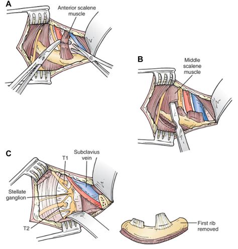 Steps Of First Rib Removal A Sharp Division Of The Anterior Scalene