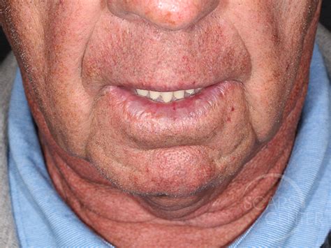 Lip Reconstruction 2 Skin Cancer And Reconstructive Surgery Center