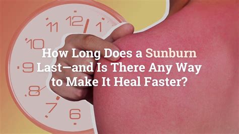 How Long Does A Sunburn Last—and Is There Any Way To Make It Heal