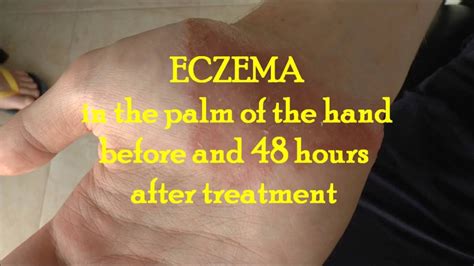 Hand Eczema Before And 48 Hours After Treatment Youtube