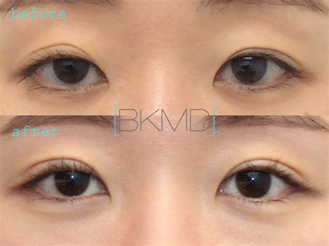 Asian Double Eyelid Surgery Blepharoplasty Nyc Dr Brett Kotlus