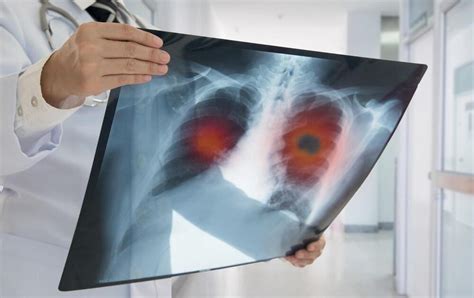 Cancerul Pulmonar Cauze Manifestari Si Optiuni De Tratament Dr Max The Best Porn Website