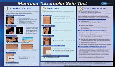 Reading Tb Skin Test Chart