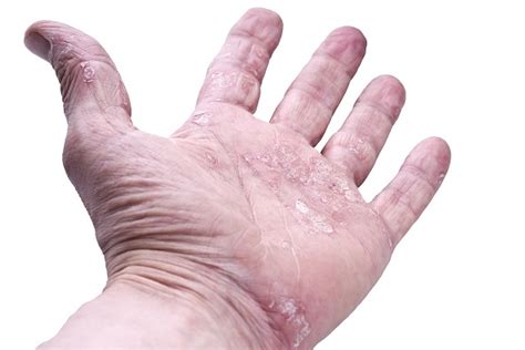 Skin Conditions — Who Is At Risk Croner I