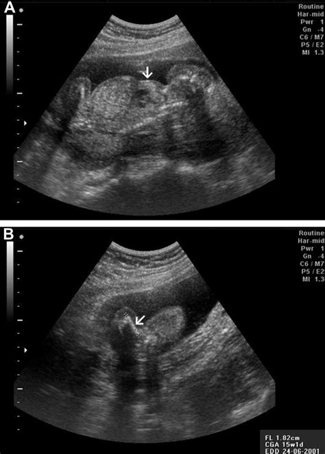 Prenatal Ultrasound At 18 Weeks Of Gestation Shows A A Narrow Thorax