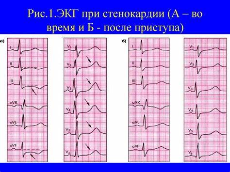 ИБС. Стенокардия. Инфаркт миокарда - презентация онлайн Картинка - ИБС. Стенокардия. Инфаркт миокарда - презентация онлайн