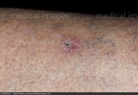 Stock Image Dermatology Basal Cell Carcinoma A Small Dark Crusted