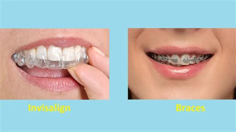 Difference Between Invisalign And Braces With Comparison Table Difference Camp
