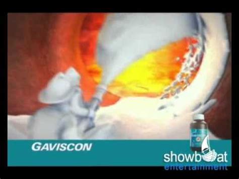 Since gaviscon® works quickly, you can eat or drink again as soon as your symptoms subside. Gaviscon : Animatic - YouTube