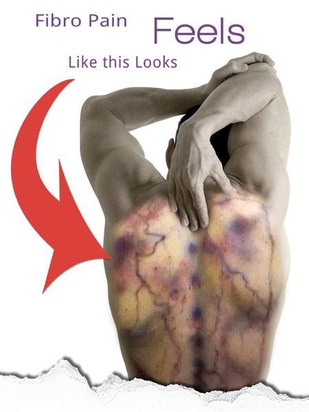 Talk to your doctor if you're experiencing persistent or worsening symptoms. After the recognition of FIBROMYALGIA! - VWSCircle.com