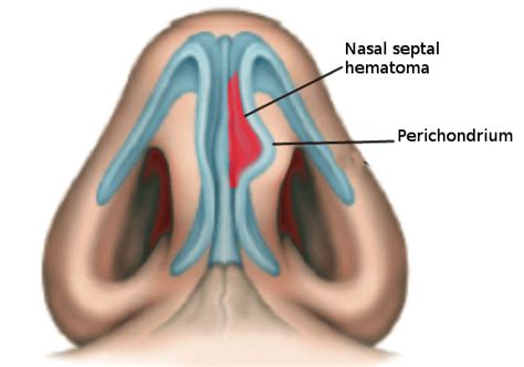 Figure Nasal Septal Hematoma Image Courtesy S Bhimji Md Statpearls Ncbi Bookshelf