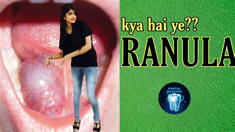 Ranula Plunging Ranula Mucocele Treatment Of Ranula Dental