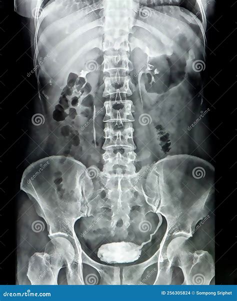 Xray Image Of Human Torso Blur And Noise Stock Photo Image Of Healthy