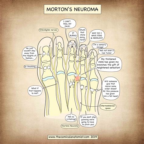 Mortons Neuroma The Comical Anatomist