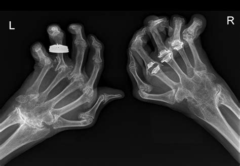 Frontal view, one or two oblique views and a lateral view are standard views. RHEUMATOID ARTHRITIS 4 | buyxraysonline