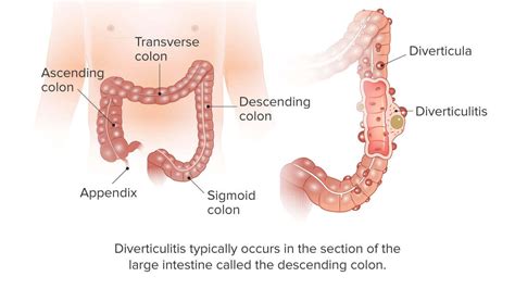 Symptoms And Causes Of Diverticulitis Health Blog