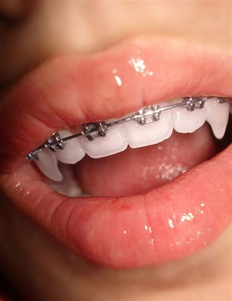 Random Radness Vol73 Vampire Teeth Teeth Aesthetic Teeth Braces