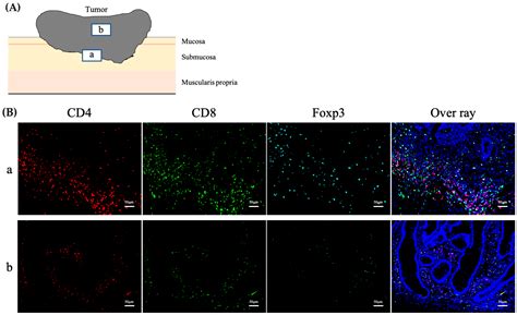 Cancers Free Full Text Investigating The Role Of Tumor Infiltrating