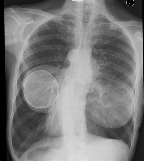 Chest Xray For The Diagnosis Of Lung Cancer