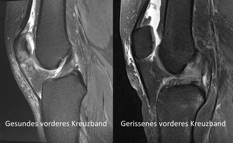 Die besten infos wann ist der richtige zeitpunkt für eine op? 47 Top Pictures Wann Op Nach Kreuzbandriss / Knie ...