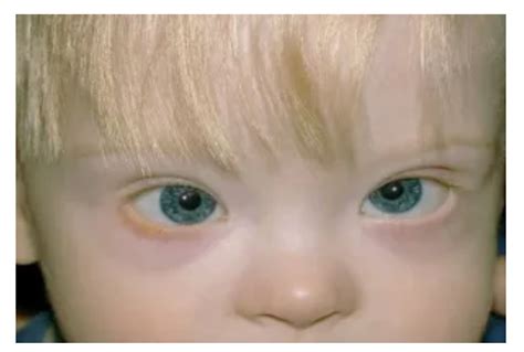 Down Syndrome Ocular Manifestation In Children Vision Science Academy