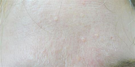 Portland Sebaceous Hyperplasia Treatment Norris Dermatology