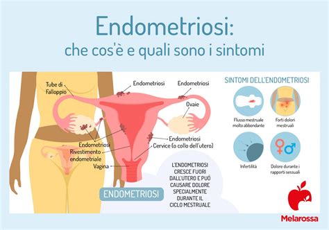 Endometriosi Cause Sintomi E Rimedi The Best Porn Website