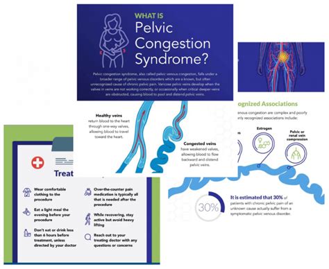 Pelvic Congestion Syndrome Treatment Ivc Interventional Vascular And Vein Center