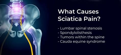 Sciatica Pain Causes Symptoms Treatments And Home Remedies
