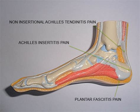 Facts About Heel Pain Insoles And Orthotics Healthy Step