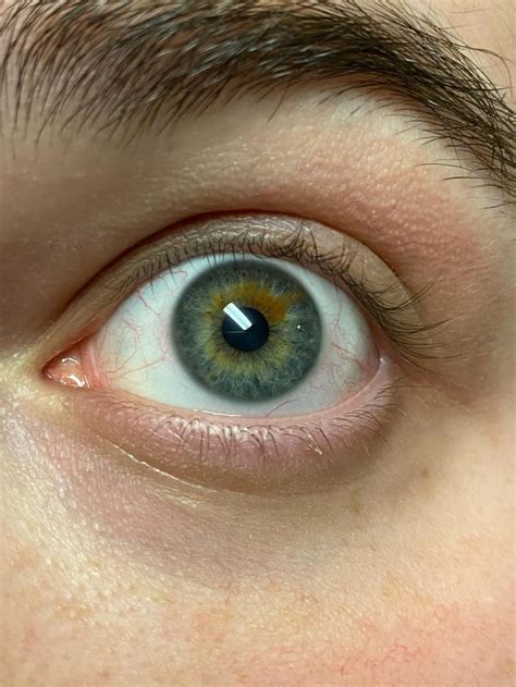 Blue Rheterochromia