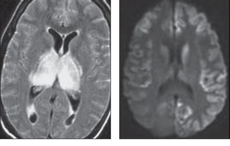 Figure 8—48 From Bilateral Thalamic Lesions Semantic Scholar