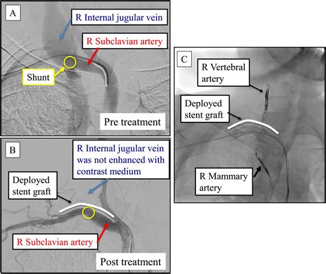 A Successful Case Of Percutaneous Fistula Closure In A Patient With