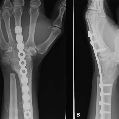 Two Years Following Wrist Fusion In A Patient With Rheumatoid Arthritis Download Scientific