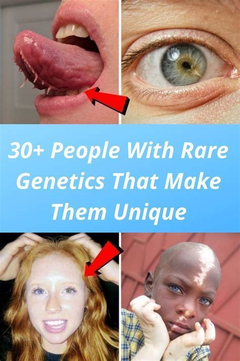 Discover The Fascinating World Of Rare Genetic Traits