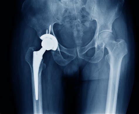 Hip Replacements Sandweg And Ager Pc