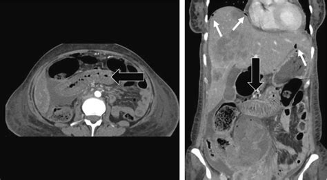 Axial And Coronal Views Of Abdomenpelvis Contrast Enhanced Ct Scan