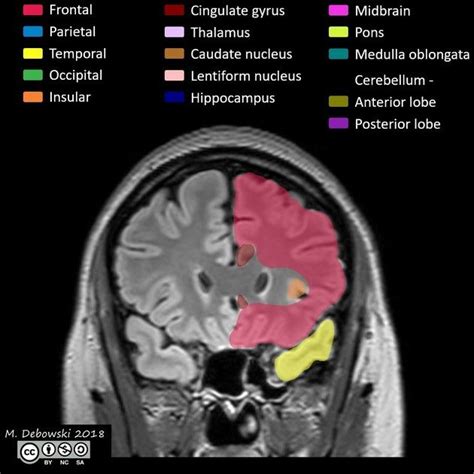 Brain Lobes Annotated Mri Radiology Case