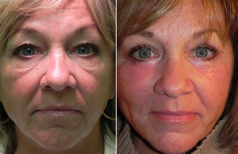 Can Cosmetic Surgery Remove Eye Bags Keweenaw Bay Indian Community