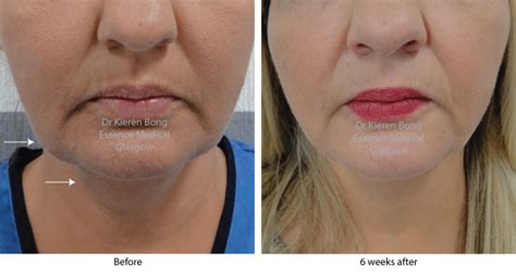 Dissolve Double Chin And Jowls With Injections