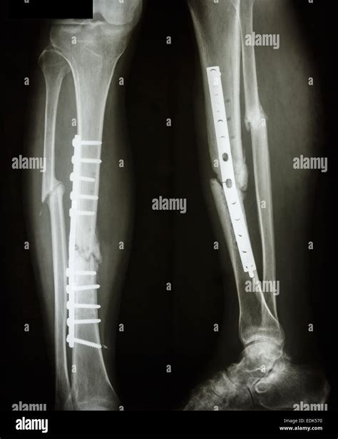 Film Leg Aplateral Show Fracture Shaft Of Tibia And Fibular Legs