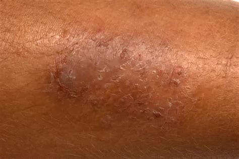 Non Contagious Skin Conditions Bumps Rashes Moles And More