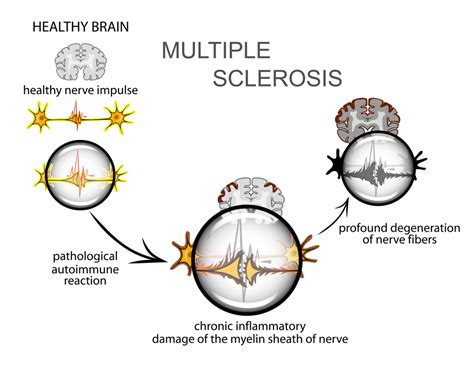 This damage results in symptoms that may include numbness, weakness, vertigo, paralysis, and involuntary muscle contractions. Multiple Sclerosis: Symptoms, Diagnosis, and Treatment ...