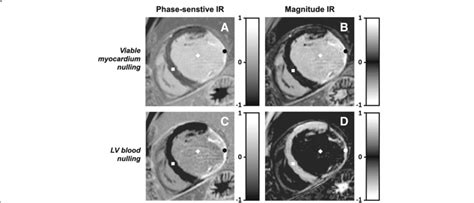 Phase Sensitive Inversion Recovery Psir And Magnitude Ir Late