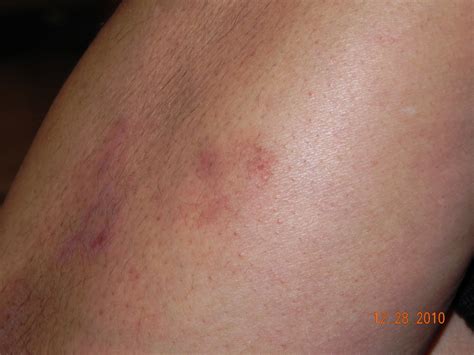 Lupus Rash Pictures On Hands