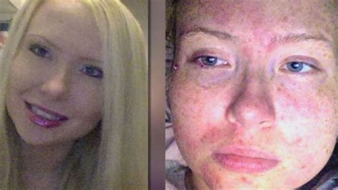 Florida Woman Suffers From A Rare Condition That Makes Her Allergic To