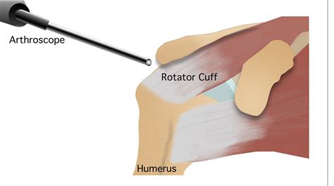 Arthroscopic Rotator Cuff Repair Florida Spine And Sports Specialists