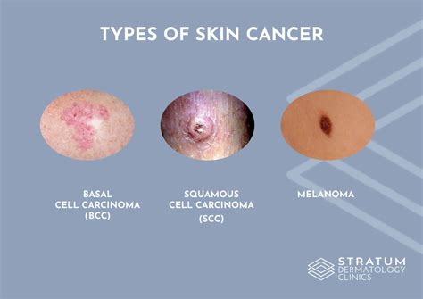 What Are The Common Types Of Skin Cancer Stratum Clinics