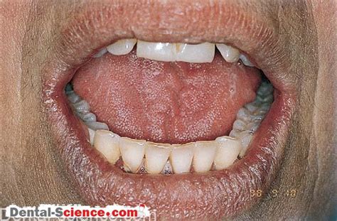 Sjögrens Syndrome Dental Science